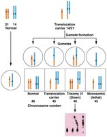 Robertsonian translocation and gamete formation
