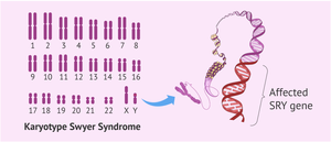 Karyotype and SRY gene in Swyer Syndrome