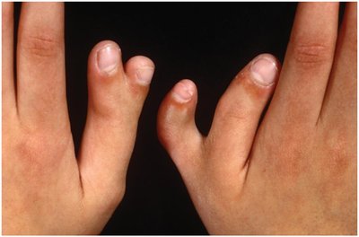 Polydactyly hands