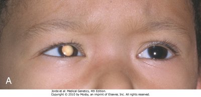 Pedigree showing reduced penetrance in retinoblastoma