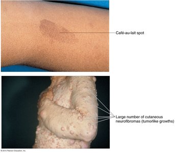 Neurofibromatosis Type 1 skin features