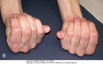 Marfan syndrome hand features
