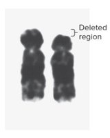 Chromosome 5 with deletion causing cri-du-chat syndrome
