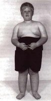 Prader-Willi syndrome phenotype