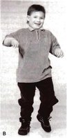 Angelman syndrome phenotype