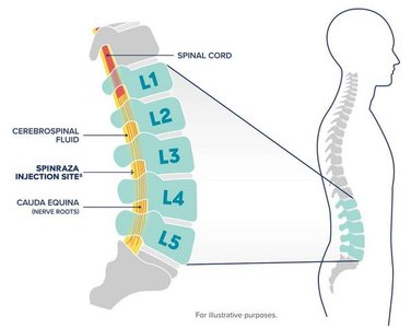Spinraza injection site in spinal cord