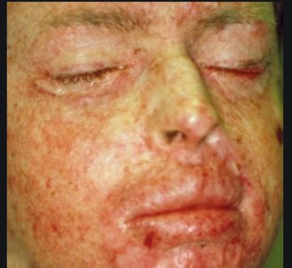 Xeroderma pigmentosum clinical presentation