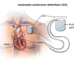 Implantable cardioverter defibrillator (ICD) diagram