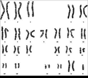 Human karyotype with G-banding