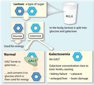 Galactosemia and dietary effects