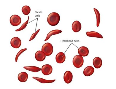 Sickle cell anemia: sickle cells vs. normal red blood cells