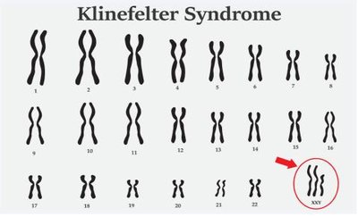 Karyotype showing Klinefelter syndrome (XXY)