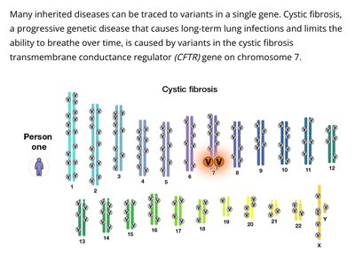 Cystic fibrosis gene mutation on chromosome 7