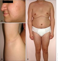 Clinical features of Klinefelter syndrome