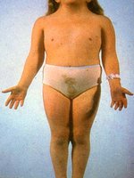 Clinical features of Turner syndrome