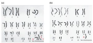Karyotype comparison: Turner syndrome and normal female