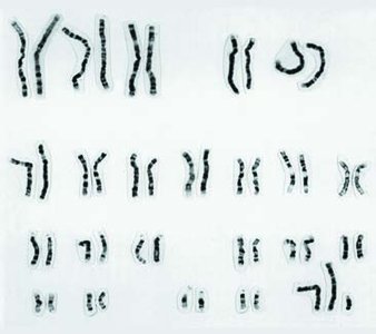 Karyotype of Klinefelter syndrome (47,XXY)