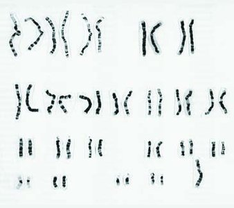 Karyotype of Turner syndrome (45,X)