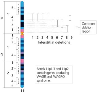 Interstitial deletions in WAGR syndrome