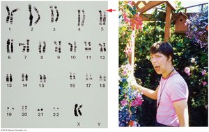Karyotype and phenotype of Cri Du Chat syndrome