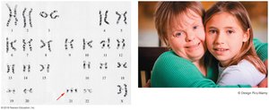 Karyotype and phenotype of Down syndrome (Trisomy 21)