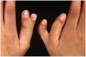 Polydactyly, an autosomal dominant trait with incomplete penetrance