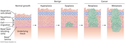 Stages of cancer progression: normal, hyperplasia, dysplasia, neoplasia, metastasis