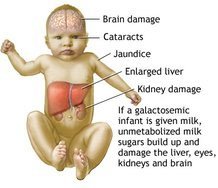Symptoms of untreated galactosemia