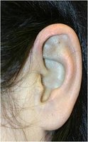 Ear with pigmentation in alkaptonuria