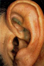Ear with pigmentation in alkaptonuria