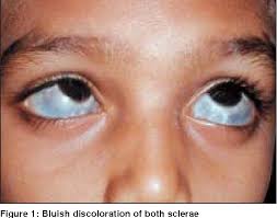 Bluish discoloration of sclera in alkaptonuria