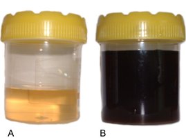 Urine samples: normal and darkened in alkaptonuria