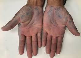 Pigmentation of palms in alkaptonuria