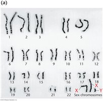 Karyotype of Klinefelter syndrome (47, XXY)