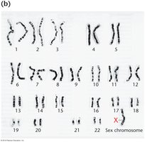 Karyotype of Turner syndrome (45, X)