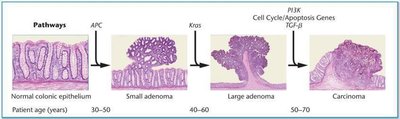 Steps in the development of colorectal cancer