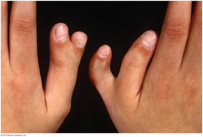 Pedigree showing penetrance