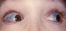 Blue sclera in osteogenesis imperfecta