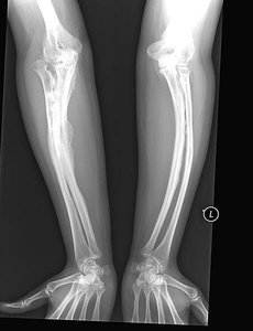 Bone deformities in osteogenesis imperfecta