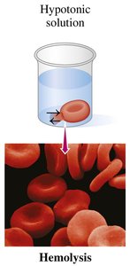 Red blood cells in hypotonic solution undergoing hemolysis