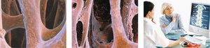 Bone density measurement using X-rays