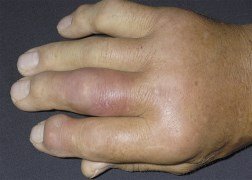 Gout due to uric acid solubility