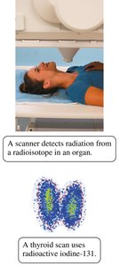 Thyroid scan with iodine-131