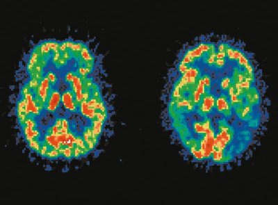PET scan of normal and Alzheimer's brain