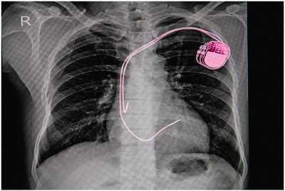 X-ray showing a pacemaker powered by a battery (redox reaction)