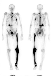 Tc-99 scan for metastatic bone cancer
