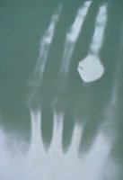 First x-ray of a human hand