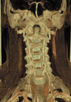 Modern CT scan of vertebrae