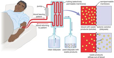 Diagram of dialysis process in a patient