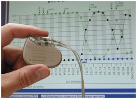 Pacemaker battery, example of redox reaction in technology